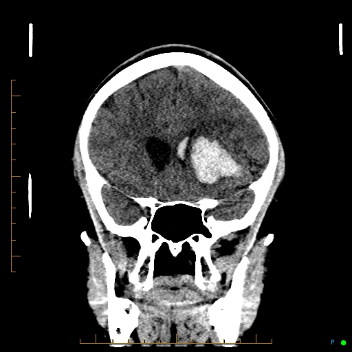Cerebral arteriovenous malformation (AVM) (Radiopaedia 78162-90706 Coronal non-contrast 35).jpg