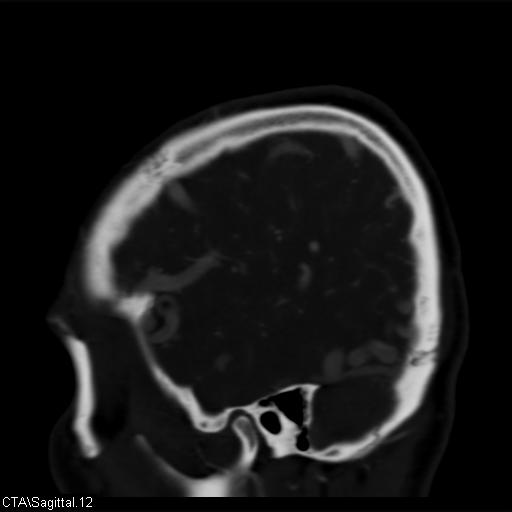 Cerebral arteriovenous malformation (Radiopaedia 28518-28759 D 9).jpg