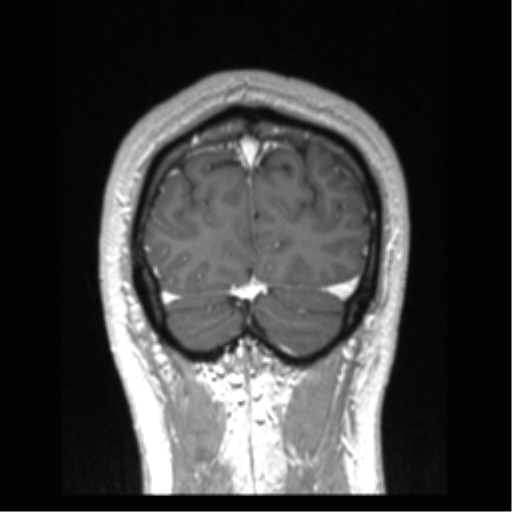 Cerebral arteriovenous malformation (Radiopaedia 39259-41506 Coronal T1 C+ 15).png