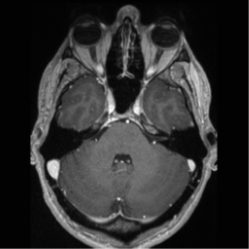 Cerebral arteriovenous malformation (Radiopaedia 55798-62372 Axial T1 C+ 20).png