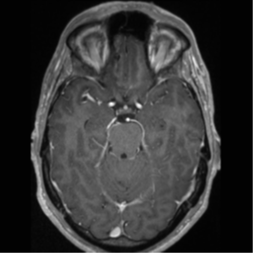 Cerebral arteriovenous malformation (Radiopaedia 55798-62372 Axial T1 C+ 27).png