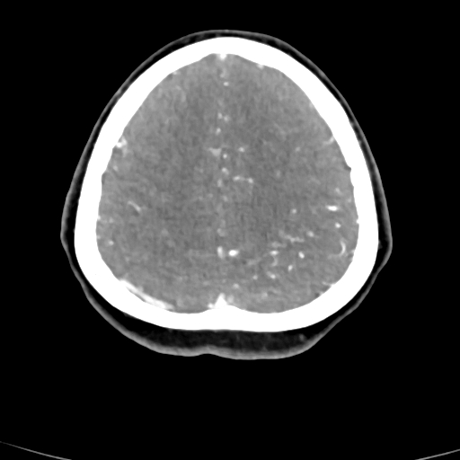 Cerebral arteriovenous malformation (Radiopaedia 73830-84645 B 21).jpg