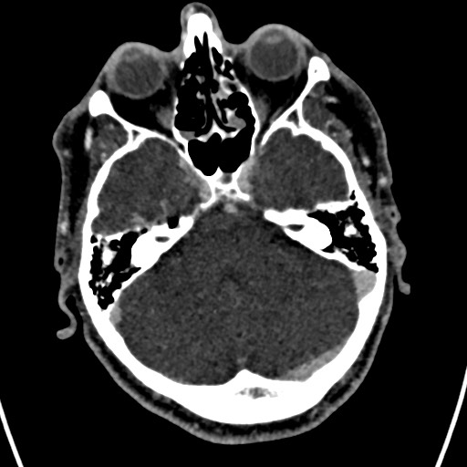 Cerebral arteriovenous malformation (Radiopaedia 78188-90746 Axial C+ delayed 47).jpg