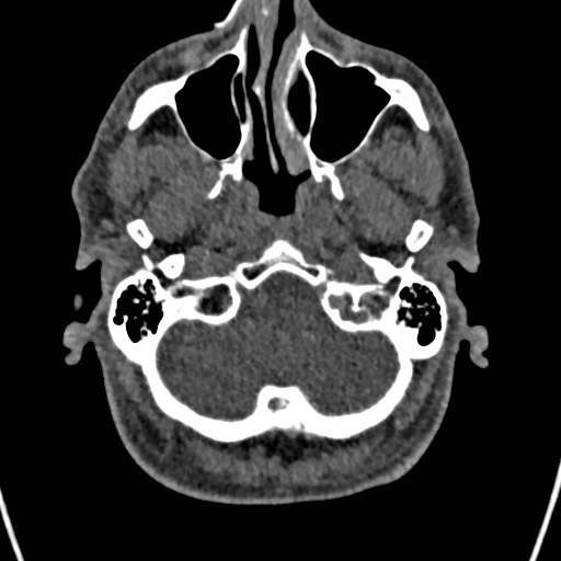 Cerebral arteriovenous malformation (Radiopaedia 78188-90746 Axial non-contrast 22).jpg