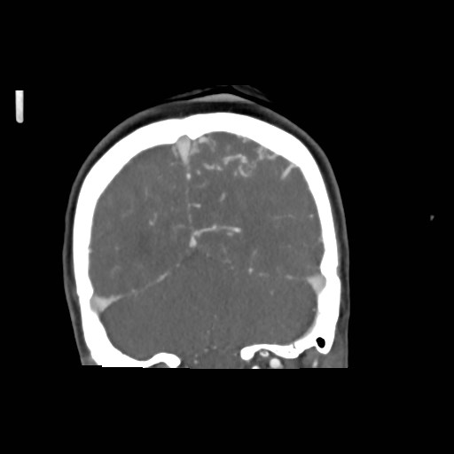 File:Cerebral arteriovenous malformation (Radiopaedia 79677-92888 B 38).jpg