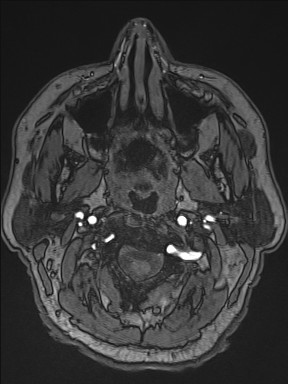 Cerebral arteriovenous malformation (Radiopaedia 84015-99245 Axial TOF 7).jpg