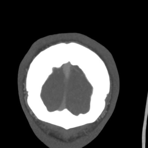 Cerebral arteriovenous malformation (Spetzler-Martin grade 2) (Radiopaedia 41262-44076 F 63).png