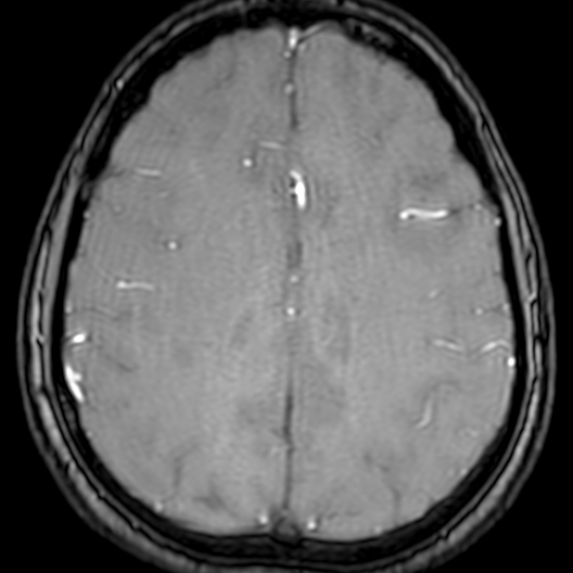 Cerebral arteriovenous malformation at posterior body of corpus callosum (Radiopaedia 74111-84925 Axial MRA 156).jpg