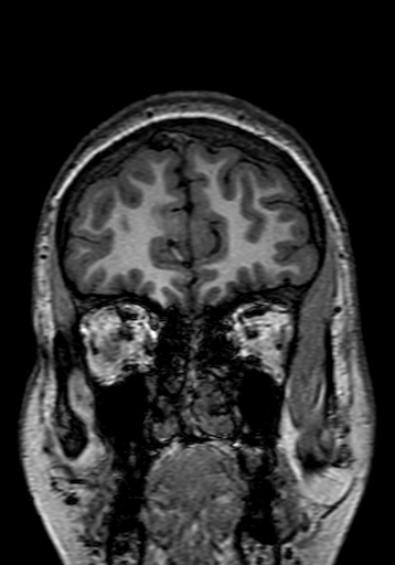 Cerebral arteriovenous malformation at posterior body of corpus callosum (Radiopaedia 74111-84925 Coronal T1 38).jpg