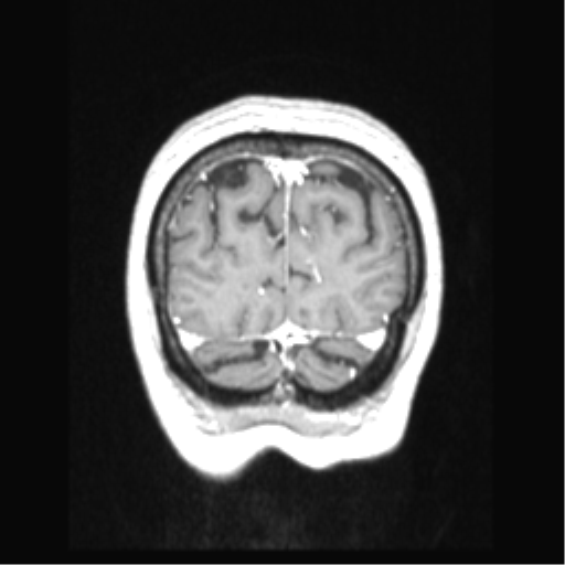 Cerebral arteriovenous malformation with hemorrhage (Radiopaedia 34422-35737 Coronal T1 C+ 14).png