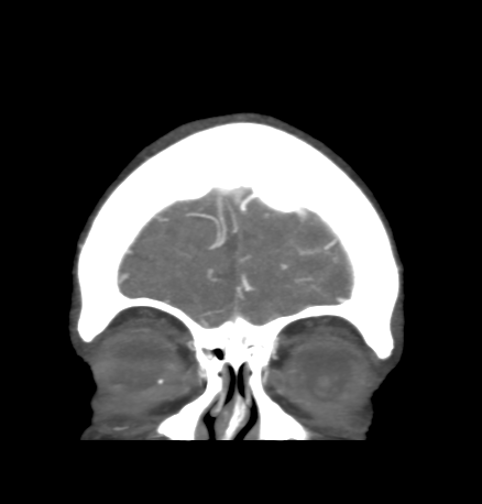 File:Cerebral arteriovenous malformation with lobar hemorrhage (Radiopaedia 44725-48511 B 8).png