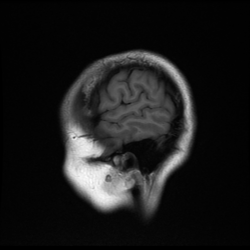 File:Cerebral autosomal dominant arteriopathy with subcortical infarcts and leukoencephalopathy (CADASIL) (Radiopaedia 41018-43768 Sagittal T1 2).png
