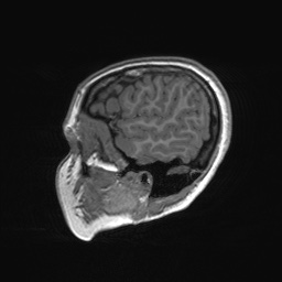 File:Cerebral cavernous venous malformation (Radiopaedia 70008-80021 Sagittal T1 65).jpg