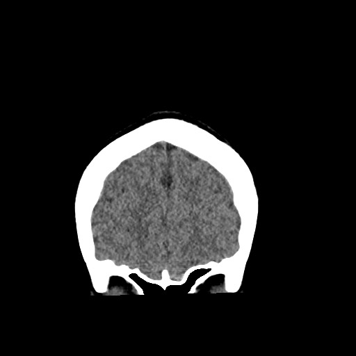 Cerebral cavernous venous malformation (Radiopaedia 70008-80022 non-contrast 11).jpg