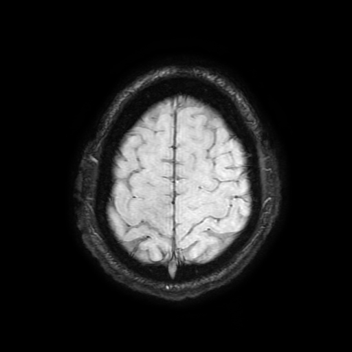 Cerebral cavernous venous malformation (Zabramski type II) (Radiopaedia 85511-101198 Axial SWI 100).jpg