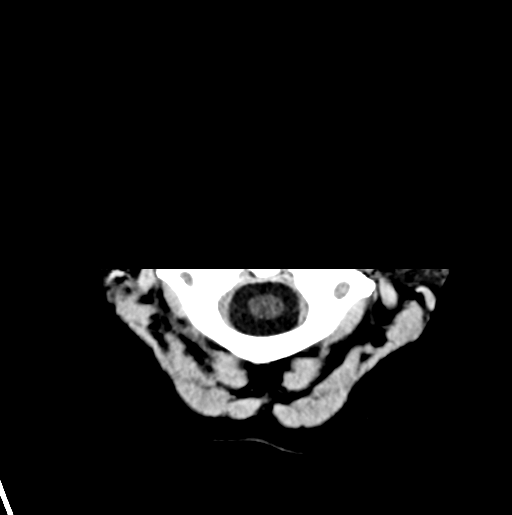 File:Cerebral cavernous venous malformations (Radiopaedia 48117-52945 Axial non-contrast 1).png