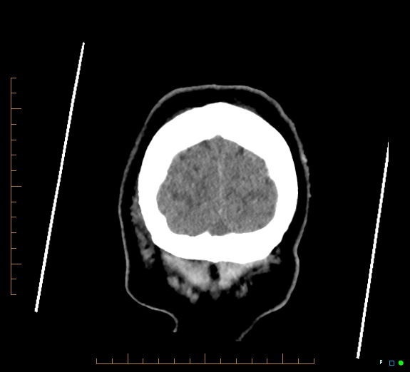 Cerebral fat embolism (Radiopaedia 85521-101220 Coronal non-contrast 58).jpg