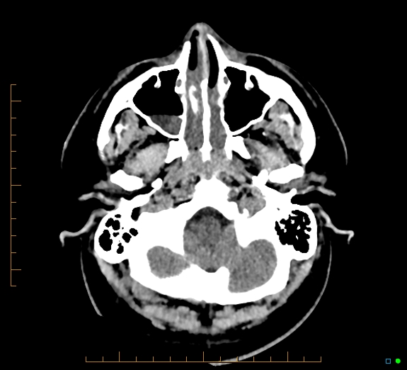 Cerebral fat embolism (Radiopaedia 85521-101224 Axial non-contrast 7).jpg