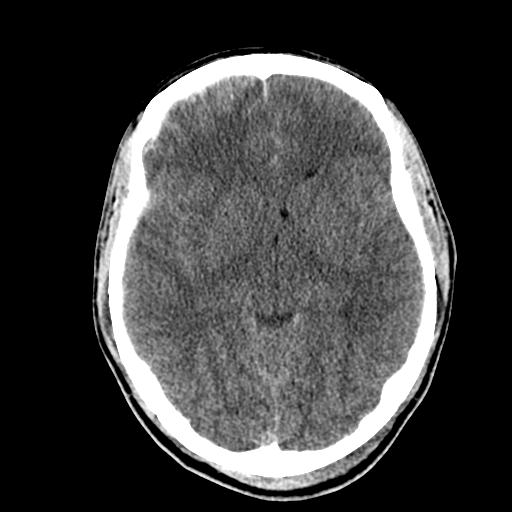 File:Cerebral hemorrhagic contusions- temporal evolution (Radiopaedia 40224-42753 Axial non-contrast 15).png