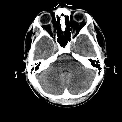 File:Cerebral hemorrhagic contusions- temporal evolution (Radiopaedia 40224-42753 Axial non-contrast 8).png