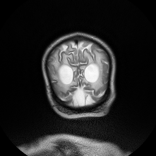 File:Cerebral manifestations of mucopolysaccharidosis type I (Radiopaedia 59171-66487 Coronal T2 20).jpg