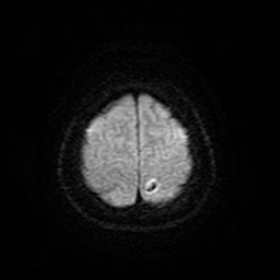 Cerebral metastases - melanoma (Radiopaedia 80972-94522 Axial DWI 26).jpg