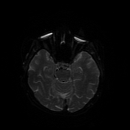 Cerebral metastases - melanoma (Radiopaedia 80972-94522 Axial DWI 76).jpg