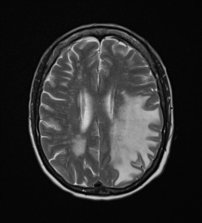 File:Cerebral metastasis (Radiopaedia 46744-51248 Axial T2 18).png