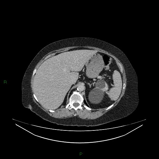 Cerebral metastasis from renal cell carcinoma (Radiopaedia 82306-96378 A 39).jpg