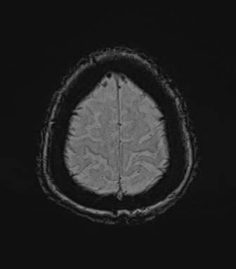 Cerebral metastasis to basal ganglia (Radiopaedia 81568-95413 Axial SWI 78).png
