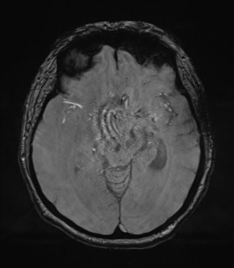 Cerebral metastasis to basal ganglia (Radiopaedia 81568-95413 Axial SWI magnitude 35).png