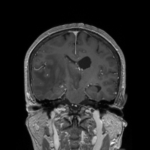 File:Cerebral metastasis to basal ganglia (Radiopaedia 81568-95413 Coronal T1 C+ 23).png