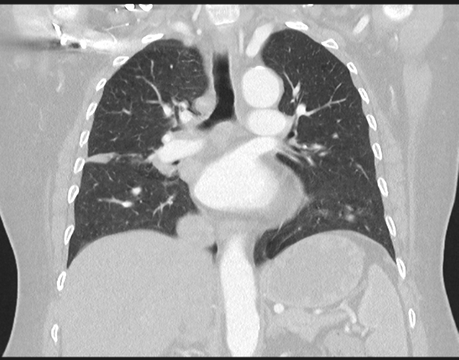 File:Cerebral metastasis to basal ganglia (Radiopaedia 81568-95414 Coronal lung window 48).png