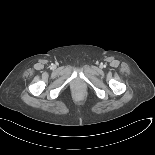 File:Cerebral metastasis to basal ganglia (Radiopaedia 81568-95414 E 81).png