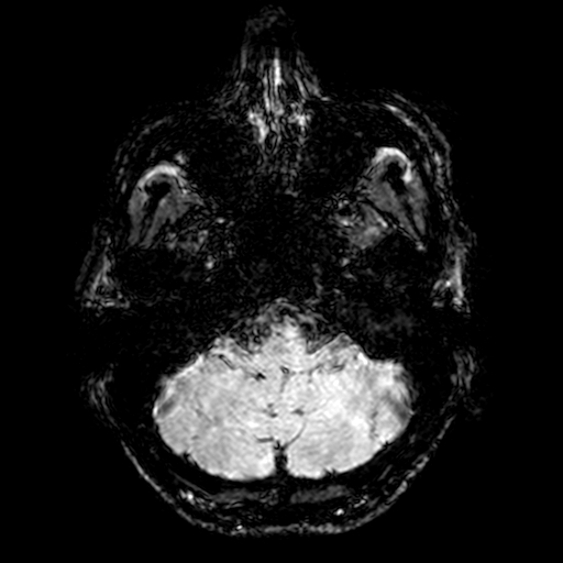 Cerebral parenchymal arteriovenous malformation (Radiopaedia 27280-27456 Axial SWI 8).jpg