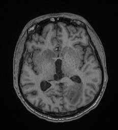 Cerebral toxoplasmosis (Radiopaedia 43956-47461 Axial T1 38).jpg