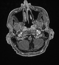 Cerebral toxoplasmosis (Radiopaedia 43956-47461 Axial T1 C+ 3).jpg