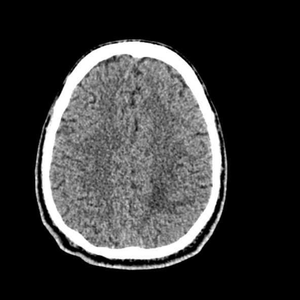 Cerebral toxoplasmosis (Radiopaedia 53993-60131 Axial non-contrast 58).jpg