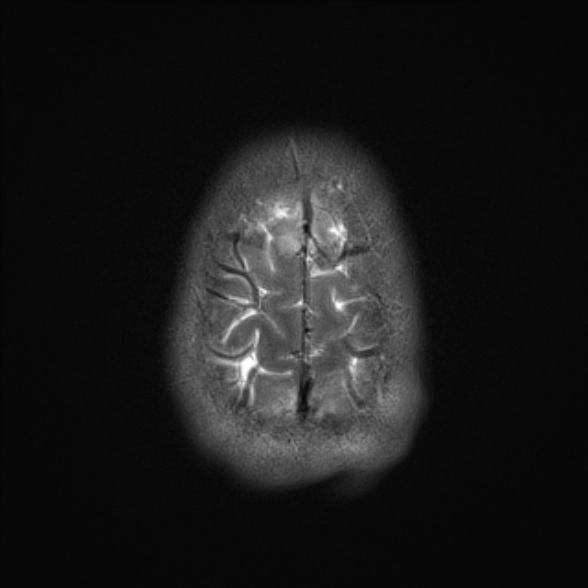 File:Cerebral toxoplasmosis (Radiopaedia 53993-60132 Axial T2 25).jpg