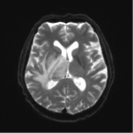 Cerebral toxoplasmosis (Radiopaedia 54575-60804 Axial DWI 18).png
