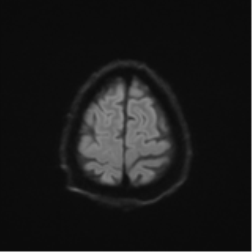 Cerebral toxoplasmosis (Radiopaedia 54575-60804 Axial DWI 60).png
