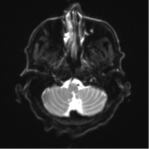Cerebral toxoplasmosis (Radiopaedia 54575-60804 Axial DWI 7).png