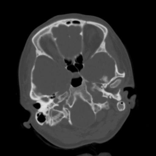 File:Cerebral tuberculosis with dural sinus invasion (Radiopaedia 60353-68018 Axial bone window 8).jpg