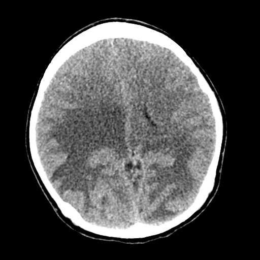 File:Cerebral tuberculosis with dural sinus invasion (Radiopaedia 60353-68018 Axial non-contrast 35).jpg