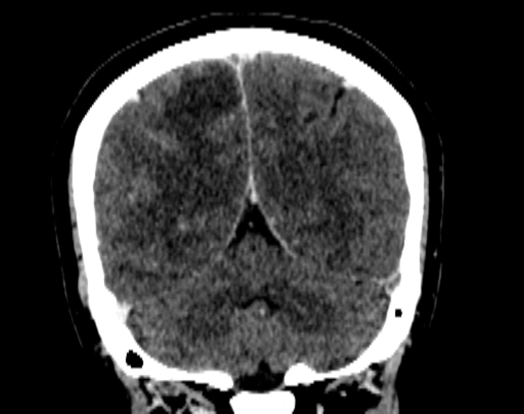 Cerebral venous hemorrhagic infarct from venous sinus thrombosis (Radiopaedia 55433-61883 Coronal C+ delayed 45).jpg
