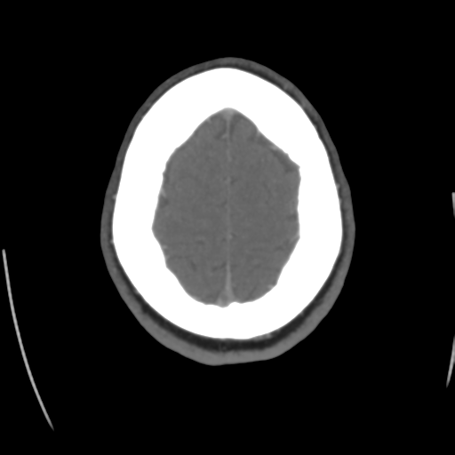 File:Cerebral venous infarct related to dural venous sinus thromboses (Radiopaedia 35292-36804 Axial C+ delayed 43).png