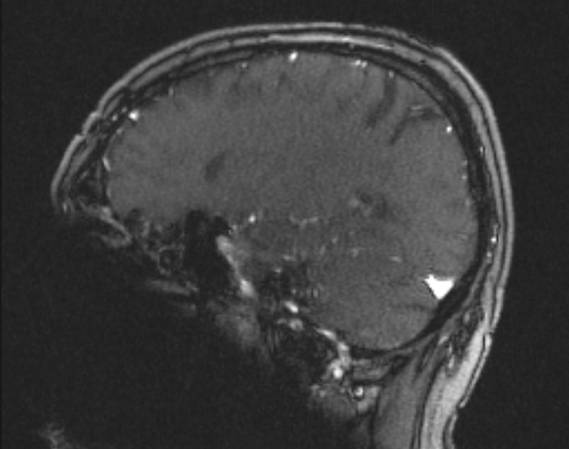 Cerebral venous infarction (Radiopaedia 65166-74176 Sagittal TOF 48).jpg
