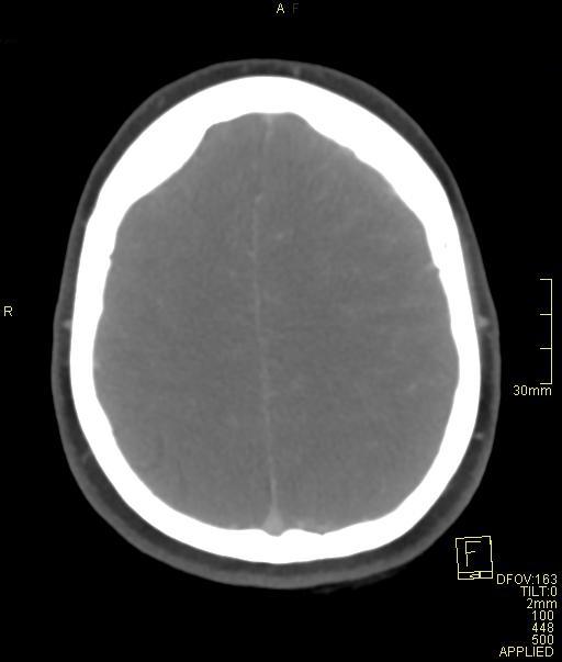 Cerebral venous sinus thrombosis (Radiopaedia 91329-108965 Axial venogram 63).jpg