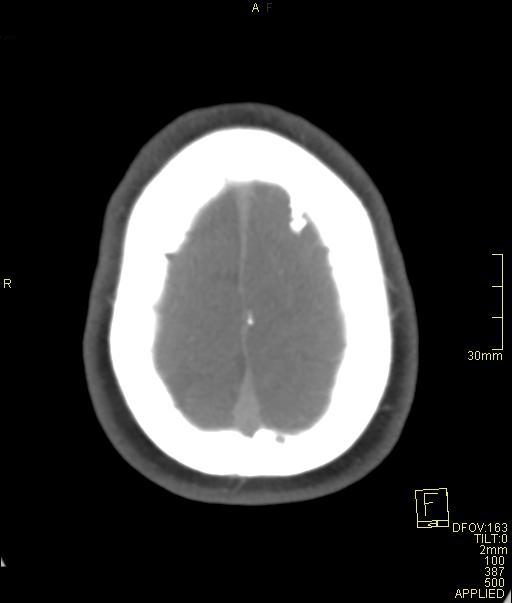 Cerebral venous sinus thrombosis (Radiopaedia 91329-108965 Axial venogram 71).jpg