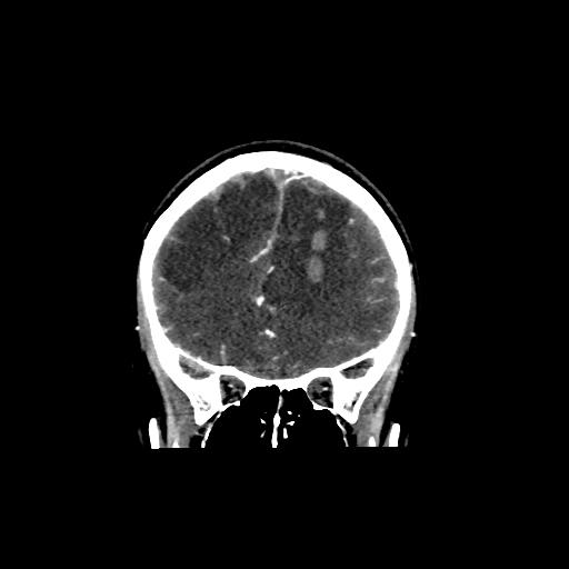 File:Cerebral venous throbmosis - hemorrhagic venous infarction (Radiopaedia 87318-103613 Coronal CT venogram 6).jpg